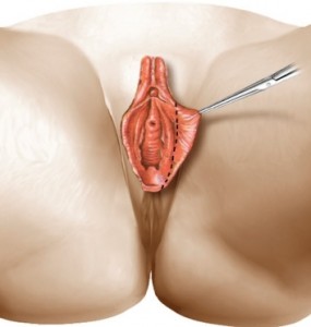 Labioplasty or Labiaplasty Trim Method