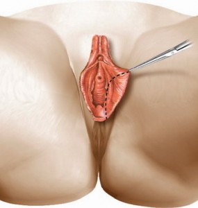 Anterior Wedge Labiaplasty