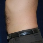 post liposuction 2 Weeks Following Liposuction