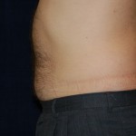 post liposuction prior to liposuction of the belly button