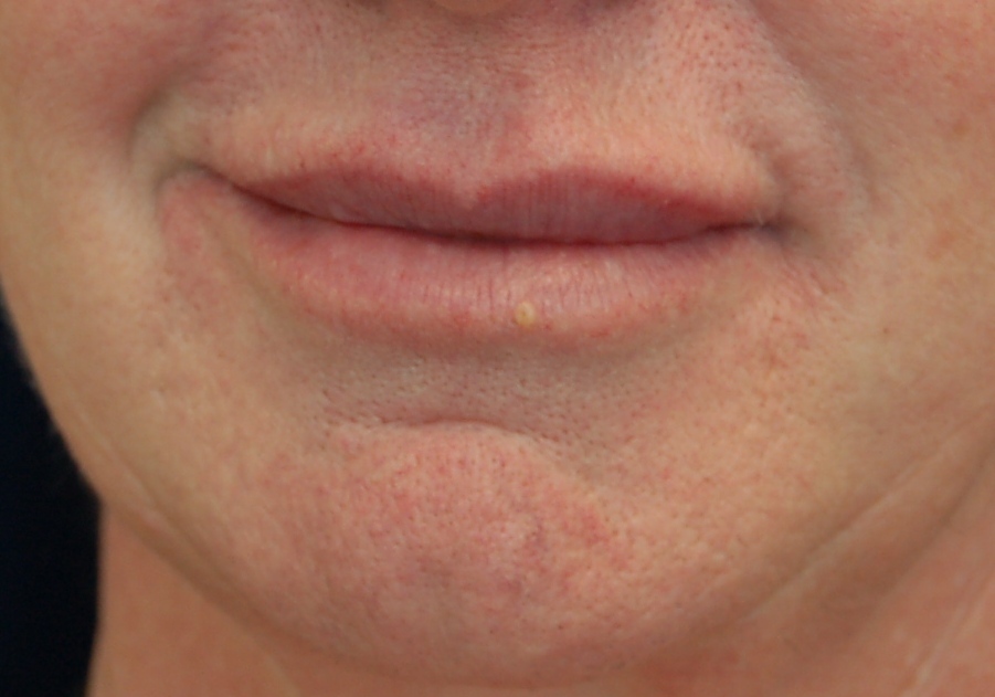 Botox Cosmetic Restylane Sculptra Sacramento Modesto California