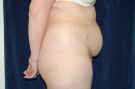 Before abdominoplasty, Patient from Folsom California
