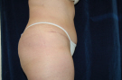 After abdominoplasty, Patient from Folsom California