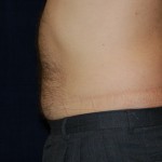 prior to liposuction of the belly button