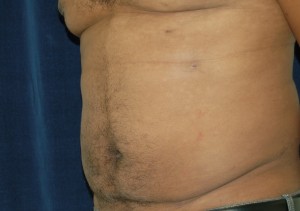 After liposuction diet and exercise