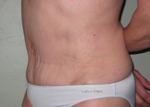 Tummy tuck after surgery