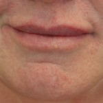 Lips follow Restylane injection Sacramento California Plastic Surgery