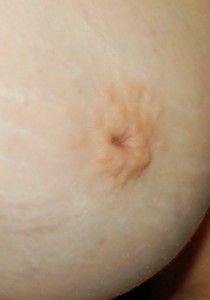 Hidden inverted nipple 