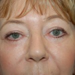 Following a upper adn lower eyelid lift in sacramento california