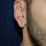 Torn earlobe repair