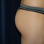 Before Structural Fat Transfer to the Buttocks By Plastic Surgeon Dr Charles Perry