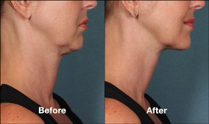kybella-bna1 2
