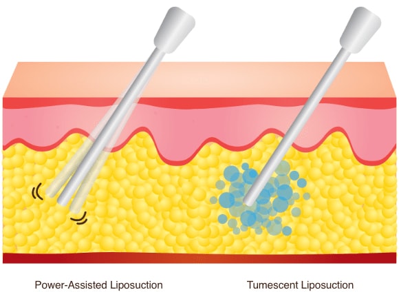 types liposuction overview image